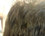does hair turn into white for dandruff