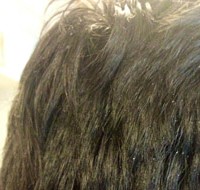 does hair turn into white for dandruff