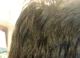 does hair turn into white for dandruff